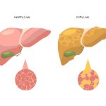 O que causa a gordura no fígado e quais os sintomas?