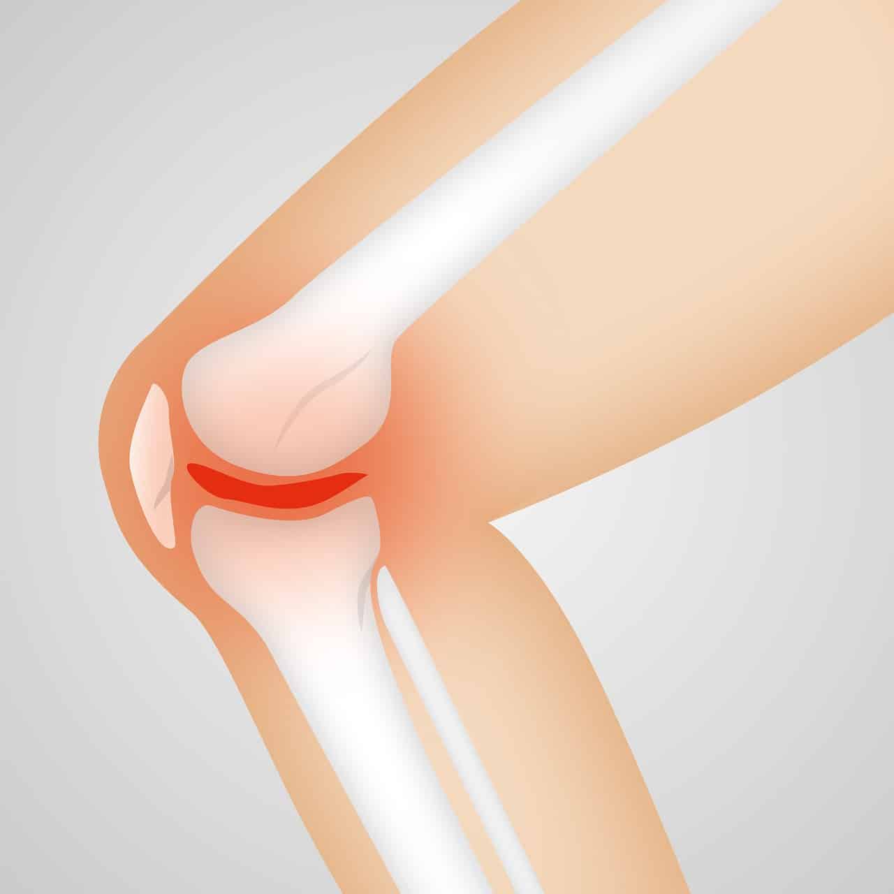 artrose no joelho tem cura?